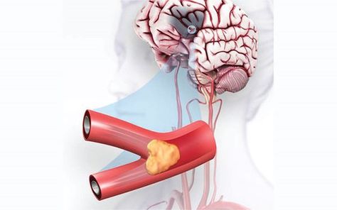 Types Of Strokes, Loss Of Balance, Brain Tissue, Brain Stem, Atrial Fibrillation, Red Day, American Heart Association, Go Red, Brain Damage