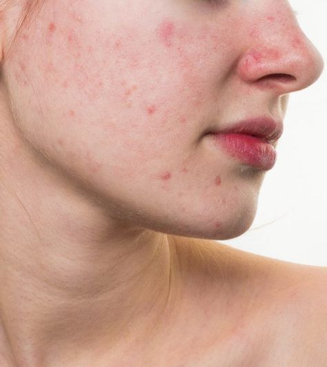 How To Get Rid Of Red Spots On Face: 6 Home Remedies And Tips Red Bumps On Face, Red Spots On Face, Redness On Face, Rash On Face, Redness Pimple, Blind Pimple, Pimples Under The Skin, Home Remedies For Skin, Skin Tightening Face