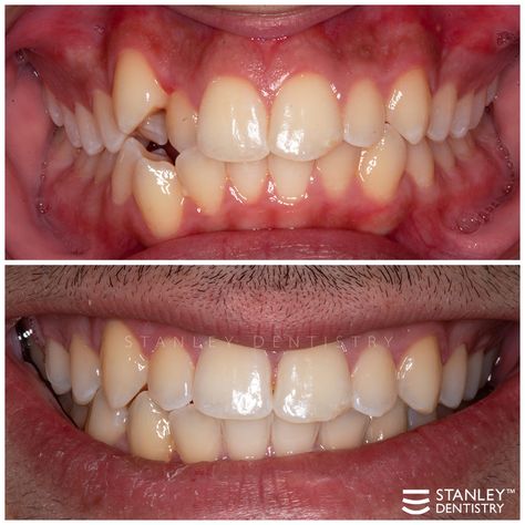 Crooked Teeth Reference, Messed Up Teeth, Teeth Study, Braces Transformation, Braces Before And After, Ceramic Braces, Straight Smile, Teeth Alignment, Cary North Carolina