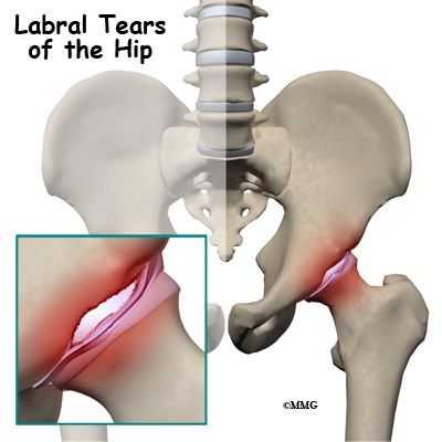 Acetabular labrum tears (labral tears) can cause pain, stiffness, and other disabling symptoms of the hip joint. Pain can occur if the labrum is damaged. Snapping Hip Syndrome, Torn Labrum, Fascia Lata, Hip Injuries, Hip Problems, Medical Procedures, Hip Surgery, Hip Dysplasia, Hip Pain