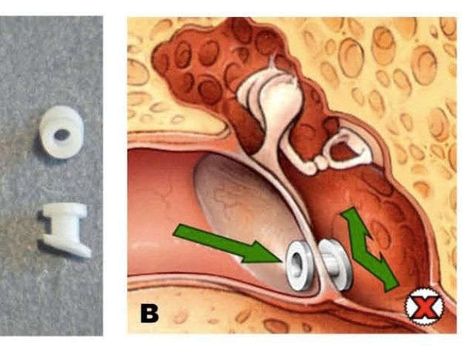 Guide: Not all kids need ear tubes to relieve fluid Eye Nerves, Fluid In Ears, How To Draw Water, Ear Tubes, Ear Picture, Ear Anatomy, Draw Water, In Ears, Health Chart