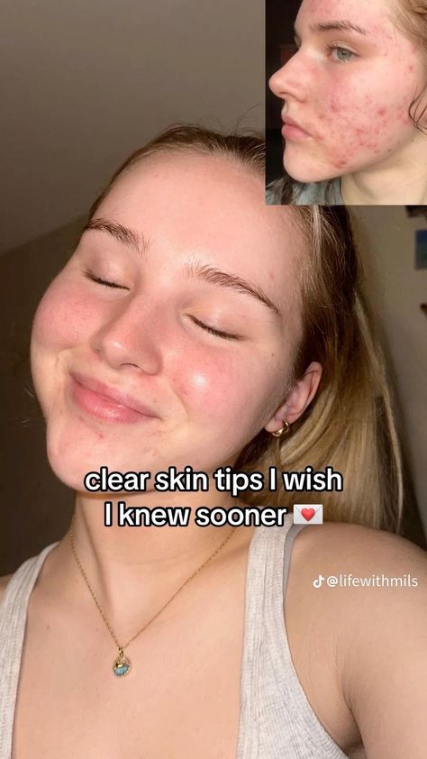 Acne healing guide Clear Acne Naturally, Healing Guide, Forehead Acne, Bad Acne, Rid Of Blackheads, Tips For Oily Skin, Cream For Oily Skin, Acne Skincare, Serious Skin Care