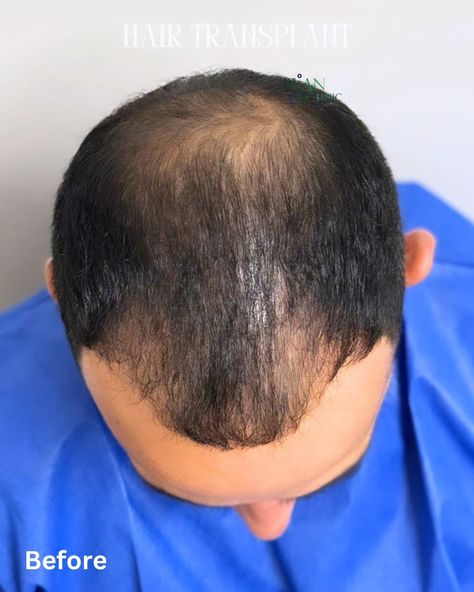 Get Your Hair Back at a Special Price! For a limited time only, take advantage of our exclusive hair transplant offer at Dr. Bijan's Clinic. Transform your look with expert care and at an unbeatable price. Don’t miss this chance to restore your confidence! **Book Now and Save!** 👇👇👇 Free video consultation --- #HairTransplant #SpecialOffer #DrBijanClinic #HairRestoration #ConfidenceBoost #LimitedTimeOffer #Aesthetic#HairLossSolution #SydneyHairClinic #sydneyhairtransplant #brisbine #goldc... Hair Clinic, Hair Back, Hair Restoration, Hair Transplant, Confidence Boost, Limited Time Offer, Free Videos, Special Price, Special Offer