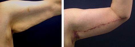 Arm Lift Before and After Photos | Brachioplasty Arm Lift Arm Lift Surgery, Before And After Pics, Arm Lift, Extra Skin, Patient Portal, Excess Skin, Facial Rejuvenation, Spa Services, After Photos