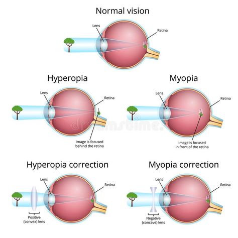 vision problems and their correction, myopia and hyperopia royalty free illustration Opthalmic Technician, Human Eye Diagram, Optician Training, Eye Health Facts, Optometry Education, Optometry School, Eyesight Problems, Perioperative Nursing, Eye Vision