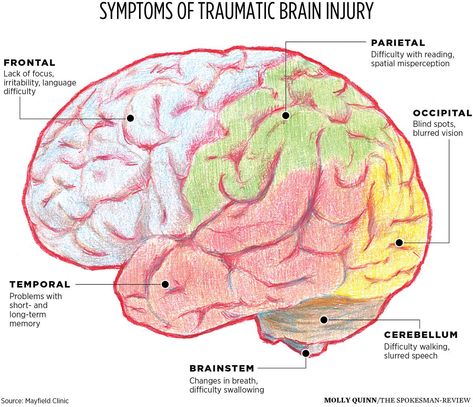 This picture indicates how each part of the brain is responsible for a different function, and how trauma can have an effect on the efficiency of those functions. It's useful for counselors to be familiar with this so that when behavior is displayed indicating trauma to a certain region, it can be identified. Recovery Yoga, Concussions Recovery, Sport Psychology, Mental Health Symptoms, Brain Injuries, Gonzaga University, Lack Of Focus, Brain Anatomy, Brain Tissue