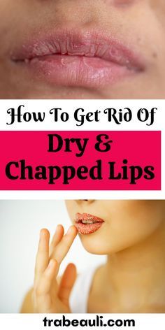 How to Get Rid of Chapped Lips in 3 Days Dry Cracked Lips Remedy, How To Fix Chapped Lips, How To Get Rid Of Chapped Lips, Dry Lips Remedy Overnight, Dry Lips Remedy, Chapped Lips Remedy, Upper Lip Hair, Dry Cracked Lips, Health Women