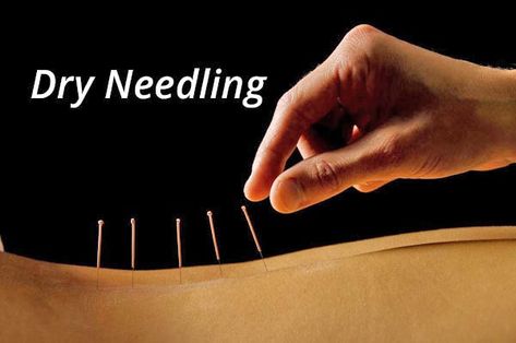 Your Top 6 Dry Needling Questions Answered - Dry Needling Therapy, Neck Sprain, Remedial Massage, Acupuncture Needles, Dry Needling, Neck Lines, Sports Therapy, Neck And Back Pain, Muscle Spasms