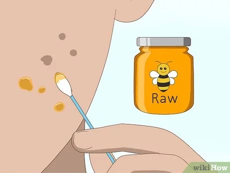 How to Get Rid of Acne Scars Fast - wikiHow Acne Scab, Pimple Scar Removal, Acne Scaring, Fade Acne Marks, Face Mapping Acne, Facial Scars, Pimple Scars, Rid Of Blackheads, Get Rid Of Acne