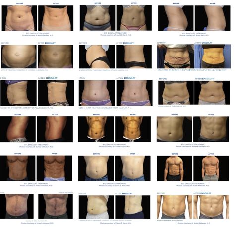 Emsculpt Before & After Photos Muscle Stimulator Before And After, Cool Sculpting Before And After Stomach, Non Invasive Body Sculpting, Body Sculpting Before And After, Emsculpt Neo Before And After, Emsculpt Before And After, Body Sculpting Room Ideas, Muscle Stimulator, Cool Sculpting