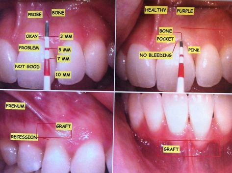 What it's Like to Get Gum Grafting Surgery Gum Graft, Dental Assistant Study, Gum Surgery, Dental Hygiene Student, Dental Videos, Gum Recession, Skin Grafting, The Teeth, Receding Gums