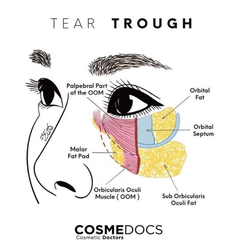 Tear Trough Filler, Face Plastic Surgery, Under Eye Hollows, Skin Anatomy, Under Eye Fillers, Face Fillers, Facial Anatomy, Tear Trough, Tears In Eyes