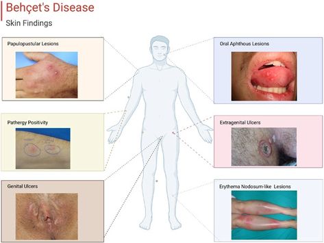 Behçet's disease skin findings. Behcets Syndrome, Skin Manifestation, Foot Reflexology Massage, Acne Vulgaris, Medical Wallpaper, Lower Extremity, Reflexology Massage, Foot Reflexology, Med School