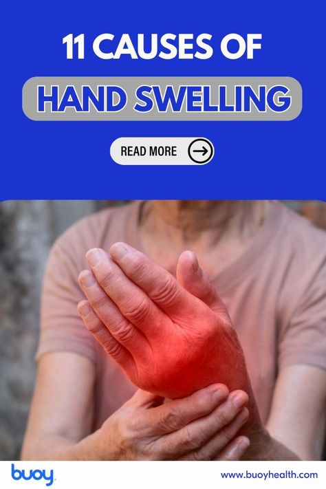 back pain treatment post Swelling Remedies, Swollen Hands, Itchy Rash, Hand Pain, Fluid Retention, Holistic Remedies, Skin Discoloration, Pain Free, Medical Conditions