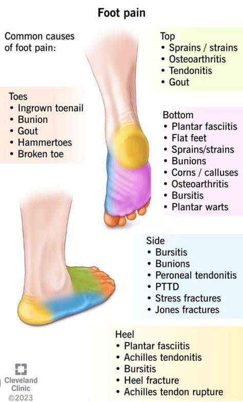 Foot Exercises For Pain, Foot Pain Chart, Therapist Notes, Gait Analysis, Doctor Things, Achilles Tendon Ruptures, Anatomy 101, Pain Chart, Sports Tips