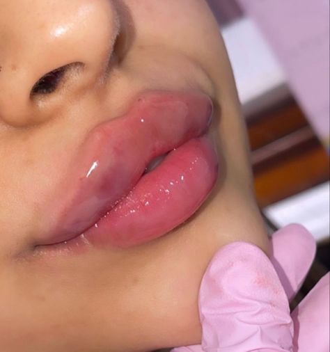 Huge Lip Fillers, Perfect Lips Natural, Lip Filler Aesthetic, Filler Inspiration, Pouty Lips, Botox Lips, Holly Dolly, Beauty Procedures, Gangsta Tattoos