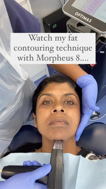 This is the technique to tighten fat using Morpheus 8…. This sub-mental fat (double chin) can increase as we age. The technology of Morpheus 8 uses deep needles at 4mm to directly target the fat pad with high heat energy to coagulate and tighten the area. Morpheus 8, Double Chin Removal, Aesthetics Clinic, Contouring Techniques, Medical Aesthetics, Heat Energy, Medical Aesthetic, Loose Skin, Double Chin