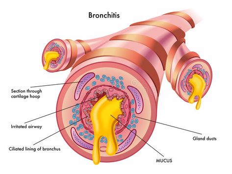 Bronchitis. Medical illustration of the effects of the bronchitis , #Aff, #Medical, #Bronchitis, #illustration, #bronchitis, #effects #ad Essential Oil For Bronchitis, Home Remedies For Bronchitis, Best Cough Remedy, Natural Decongestant, Cough Relief, Essential Oils For Pain, Asthma Attacks, Essential Oil Benefits, Natural Cough Remedies