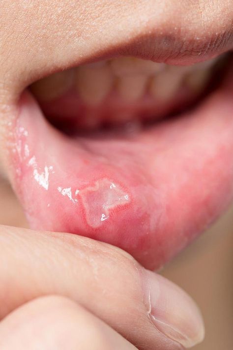 Mouth Ulcers have the appearance of tiny swelling red boils with white or yellow spots. They are found inside your mouth, such as the lips, inner cheek, and palate. #WhyOralCareIsImportant Ulcer Remedies Mouth, Baby Tooth Decay, Strong Teeth, Coconut Oil For Teeth, Cold Sores Remedies, Stronger Teeth, Gum Care, Oral Care Routine, Cold Home Remedies