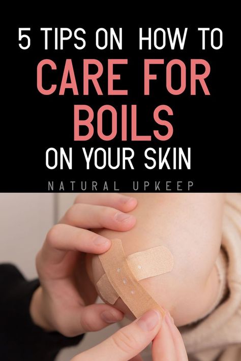 Boil Remedies, Get Rid Of Boils, Home Remedy For Boils, Skin Boil, Under The Skin, Daily Health Tips, Best Soap, Skin Remedies, How To Treat Acne