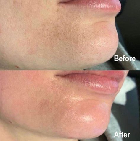 Hydrafacial Before And After, Facial Before And After, Natural Remedies For Acne, Facial Pictures, Remedies For Acne, Before And After Pics, Hydra Facial, Natural Acne Remedies, Skin Care Spa