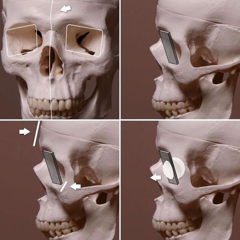 Stephen Bauman, artist & teacher on Instagram: "Things you need to know about the eye socket when drawing a portrait:  1. Sockets tilt downward at the outer edge 2. Socket is a downward facing plane 3. Flanked above and below by up facing planes 4. Eyeball breaks the plane of the socket and causes upper eyelid to face upward 👌  #academicartwork #ateliertraining #atelierart #traditionalartwork #traditionalpainting #oilpainting #instaartwork #instaart #realistart #realistpainting #realisticdrawing #atelierforum" Eye Socket Drawing, Stephen Bauman, Eye Sculpture, Drawing A Portrait, Planes Of The Face, Eye Structure, Human Anatomy Reference, Eye Socket, Skull Anatomy