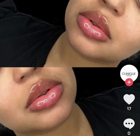 Round Lip Filler Shape, Lip Fillers Round, Heart Shaped Lip Filler, Lips Fillers Shapes, Thick Lips Aesthetic, Lip Filler Black Women, 0.5ml Lip Filler Before And After, Lip Filler Before And After, 1ml Lip Filler