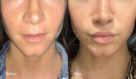 upper lip lift orlando, what is an upper lip lift, upper lip lift surgery, hz plastic surgery Corner Lip Lift, Lip Lift Surgery Before And After, Lip Lift Before And After, Lip Plastic Surgery, Lip Lift Surgery, Upper Lip Lift, Surgery Inspiration, Lip Implants, Nose Surgery Rhinoplasty