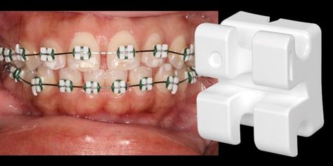 Because your smile deserves more than “one size fits all" we offer LightForce custom 3D printed ceramic braces made just for you! Heart Shaped Braces, Lightforce Braces, Braces Heart Shaped, Self Ligating Braces, Orthodontic Shirts Braces, Ceramic Braces, Brace Teeth Meme, Braces, Nail Polish