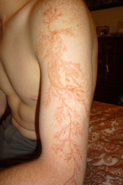 Lichtenberg figure Lightning Scar, Lichtenberg Figures, Lightning Tattoo, Struck By Lightning, Fractal Patterns, E Mc2, Lightning Strikes, Blender 3d, Science And Nature