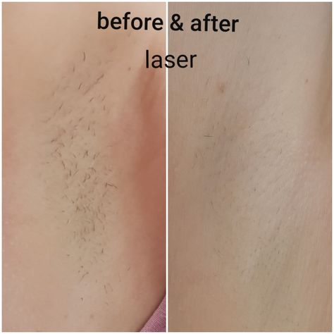 Before And After Hair, Laser Clinic, Laser Clinics, Coffee Obsession, Laser Hair, Laser Hair Removal, Hair Removal, Surgery, Tattoo Quotes