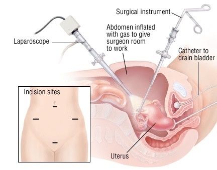 Rectal Prolapse, Abdominal Surgery, Laparoscopic Surgery, Medical Tests, Best Hospitals, Bangalore, Surgery, Health Tips, Nursing