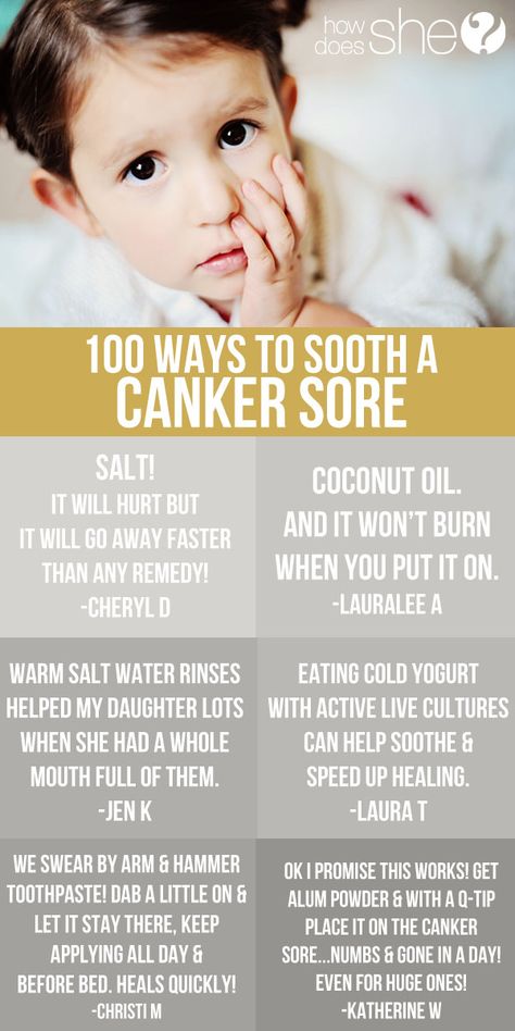 100 Ways to Soothe a Canker Sore! Get rid of those miserable things fast! #howdoesshe #cankersore Canker Sore Remedy, Canker Sore, Cold Sore, Lose 40 Pounds, Tooth Decay, Natural Home Remedies, Health And Beauty Tips, Natural Medicine, Oral Health