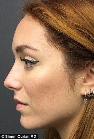 After Dr Ourian used fillers to alter its shape she was left with the straight profile she'd always dreamed of (pictured after the non-surgical nose job) Nose Job Straight, Straight Nose Profile, High Radix Nose, Straight Small Nose, Straight Nose Side Profile, Lip Art Painting, Dream Nose, Face Ref, Convex Profile