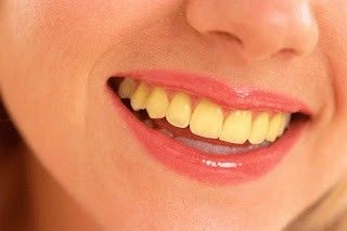 Best Teeth Whitening Kit, Discolored Teeth, Teeth Whitening Remedies, Laser Teeth Whitening, Perfect Teeth, Yellow Teeth, Tooth Enamel, Natural Teeth Whitening, Under Eye Bags