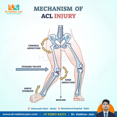 ACL surgery, ACL Injury, Mechanism Acl Knee, Acl Injury, Knee Ligaments, Acl Surgery, Orthopedic Doctor, Ligament Injury, Knee Replacement Surgery, Knee Replacement, Sports Injury