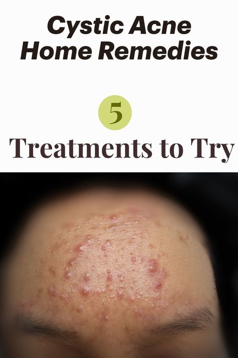 Natural Remedies Bad Acne Remedies, Natural Remedies For Cystic Acne, Natural Remedy For Acne, Home Remedy For Acne, Natural Remedies For Acne, Acne Home Remedies, Severe Acne Remedies, Painful Acne, Back Acne Remedies