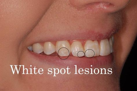 How To Get Rid Of White Spots On Teeth, Teeth Fangs Natural, Teeth After Braces, White Spots On Teeth, White Spots On Nails, Tooth Brushing Chart, Dental Animation, Best Toothpaste, Medical Animation