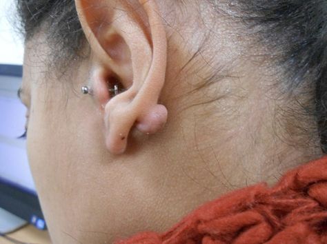 When you make a piercing for your earring, you may get #keloids. But a skilled and experienced ENT #doctor can quickly heal that and make you look fabulous. #ent #entdoctir What Causes Pimples, Pimple Causes, Ent Doctor, Double Ear Piercings, Skin Issues, Ear Piercing, Blackhead Remover, Reduce Wrinkles, Blackheads