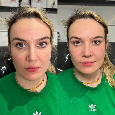 Tear Trough Filler before & afters 🪄 📍 84 Haverstock Hill, NW3 2BD 🏆 Award Winning Clinic 💰 £250 🔗 Link in bio to book ❤️ Tear Trough Filler Before After, Tear Trough