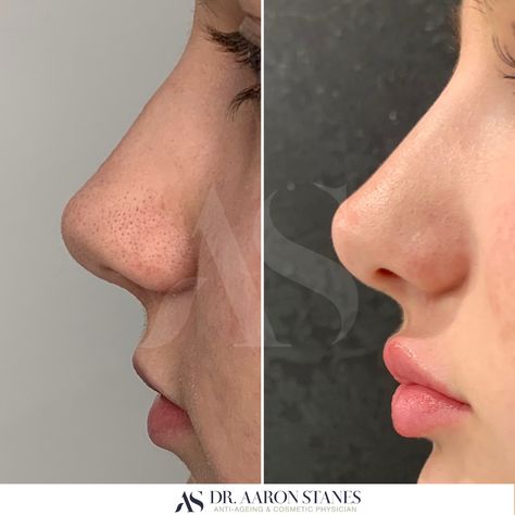 Lip Filler Before And After Side Profile, Small Alar Base Nose, Cute Noses Profile, Side Nose Profile, Lip Fillers Side Profile, Front Nose Profile, Chin Side Profile, Lip Filler Side Profile, High Nose Bridge Side Profile