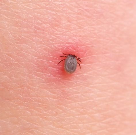 Essential Oils For Tick Bites, How To Remove Ticks From People, Removing A Tick From A Person, Tick Removal Human, Tick Bites On Humans, Bug Bite Remedies, Tick Bites Pictures, Tick Bite Symptoms, Natural Bug Bite Remedy