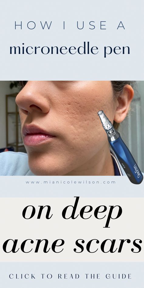 Microneedling for acne scars how to use a Microneedling pen Deep Acne Scar Removal, Pitted Acne Scar Removal, How To Fix Acne Scarring, Dermarolling Face, Microneedling Procedure, Face Acne Remedies, At Home Microneedling, Acne Pit Scars, Microneedling At Home