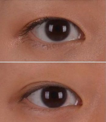 Monolid Vs Double Eyelid, Double Lid Eye, Plastic Aesthetic, Forehead Lift, Eye Images, Upper Eyelid, Double Eyelid, Brow Lift, Eye Surgery