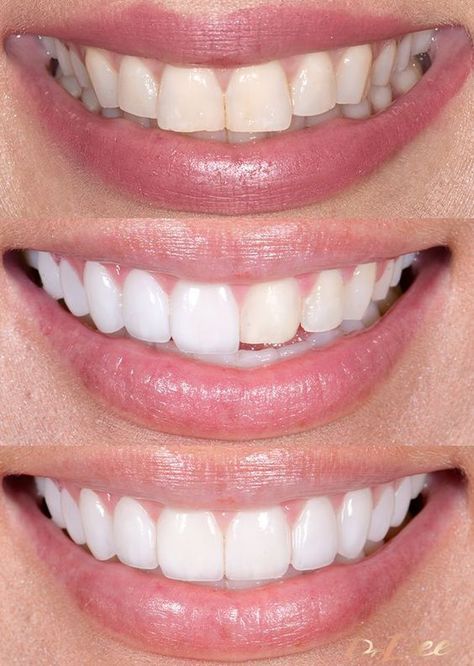 Porcelain Veneers Best Veneers Teeth, Tooth Veneers, Natural Veneers, Perfect Smile Teeth, Natural Smile, Pretty Teeth, Veneers Teeth, Beautiful Teeth, Porcelain Veneers