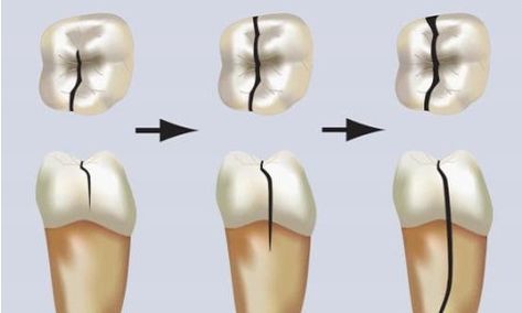 Cracked tooth refers to tiny fissures on molars caused by long-term chewing Cracked Tooth, Dental Fillings, Dental Problems, Beer Opener, Mouth Guard, Root Canal, Dental Care