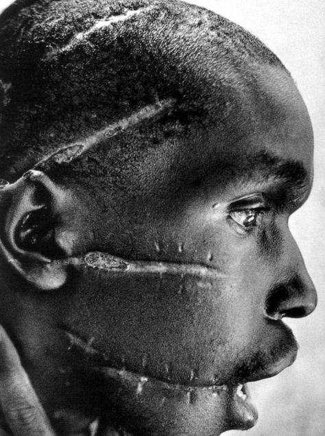 Rwanda. 1994 - A Hutu man at a Red Cross hospital, his face mutilated by the Hutu 'Interahamwe' militia, who suspected him of sympathizing with the Tutsi rebels. (James Nachtwey) This famous picture has been reproduced many, many times. I think this is one of the best crops and captions I've seen. James Nachtwey, August Sander, Famous Pictures, Steve Mccurry, Theme Tattoo, Afro Punk, Black Man, Documentary Photography, Interesting Faces