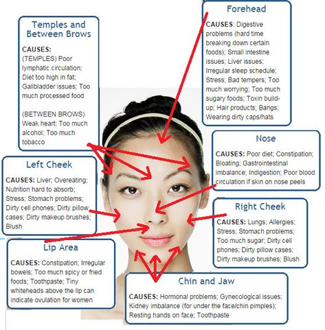 Causes Of Pimples On Face, Acne On Temples, Pimple Face Mapping, Doterra Acne, Gesicht Mapping, Face Map, Body Board, Face Mapping Acne, Liver Issues