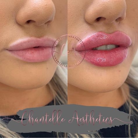 DETAILS BELOW: .📍 Manchester, UK 🇬🇧 .✖️ Chantelle Aesthetics . 👩🏼‍⚕️ Nurse . 📷 @chantelleaesthetics . . #lips #dermalfiller #filler… Bad Lip Injections, Aesthetics Nurse, Dermal Fillers Lips, Lips Inspiration, Botox Lips, Kylie Jenner Lips, Facial Fillers, Gel Toe Nails, Injectables Fillers