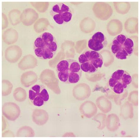 Histology: This is what you're really made of... — Histology Look-a-like #117 Adult T-cell leukemia... V Purple, Medical Laboratory Science Student, Medical Laboratory Technician, Med Lab, Medical Laboratory Scientist, Lab Design, Medical Marketing, Medical Laboratory Science, T Cell